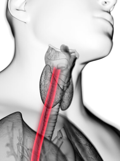 Difficulty Swallowing and Eosinophilic Esophagitis EoE