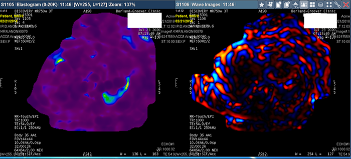 Elastography for NASH Clinical Trials