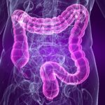 Colon Cancer Prevention