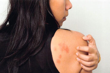 Atopic Dermatitis