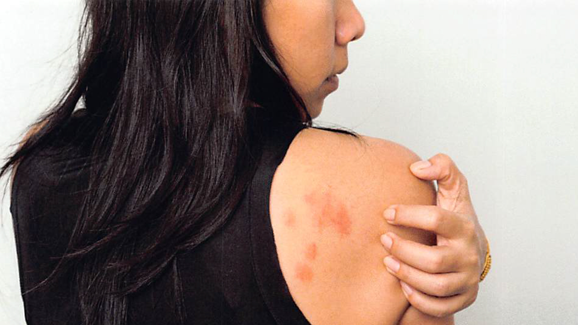 Atopic Dermatitis
